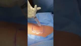 Split Thickness Skin Graft Harvest