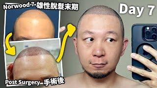 終於做了！植髮手術！｜植飛日本全記錄【1】2500 grafts hair transplant, Norwood  7, Day 0 to 7