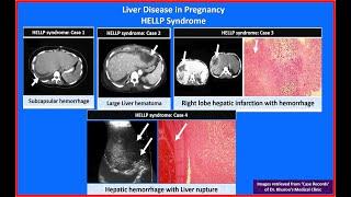 Liver Disease in Pregnancy