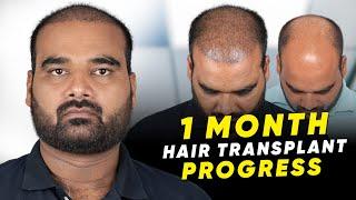 Hair Transplant in Kota | Best Results & Cost of Hair Transplant in Kota