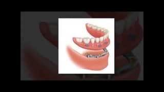 Implant Supported Dentures Houston