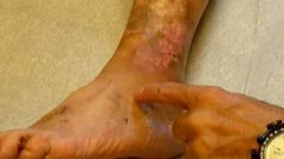 Dr H Karamanoukian - sclerotherapy and venous ulcer
