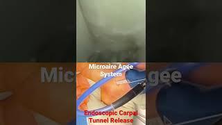 Right Endoscopic Carpal Tunnel Release