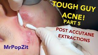 Tough guy acne! Cleaning out his last clogged pores. Every technique used. So many plugs expressed!