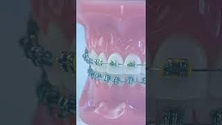 What Braces Colors To Avoid