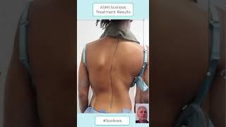 4 Sessions of the Amazing Non-Surgical ASMI Treatment for Scoliosis #scoliosistherapy