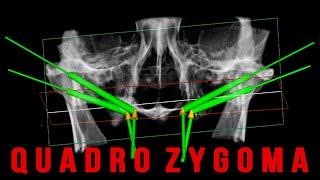 Quadro Zygoma - Full guided protocol