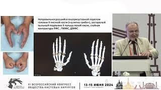 Обухов И.А.: метод дистракции в восстановлениии реконструкции суставов трубчатых костей кисти.