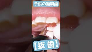 Kid's Excess Tooth Removed