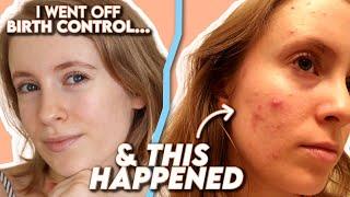 Spironolactone: How I Cleared My Hormonal Acne (+ Tretinoin) | Before & After, Side Effects, Results