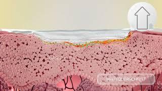 Biatain® Silicone: Exsudat- und Keimbindung