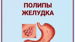 Почему образуются полипы в желудке