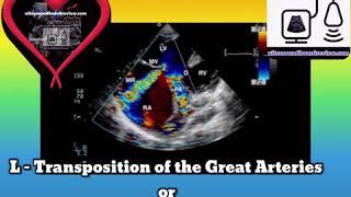 Corrected Transposition of the Great Arteries, Pulmonic Stenosis, Inlet VSD, Ultrasound Board Review