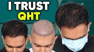 Hair Transplant in Udaipur | Best Results & Cost of Hair Transplant in Udaipur