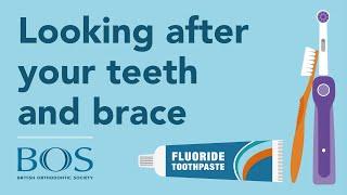 Looking After Your Teeth and Brace: Top Tips | Cleaning | Foods to Avoid | Breakages