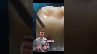 Huge Cavity  in a Dead  Tooth 