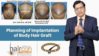 Planning of Implantation of Body Hair Graft | Dr. Anil Garg