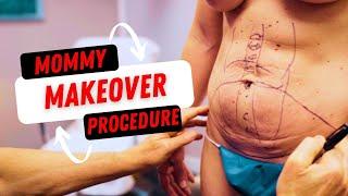 Mommy Makeover Transformation: Breast Implant Replacement, Tummy Tuck & Liposuction