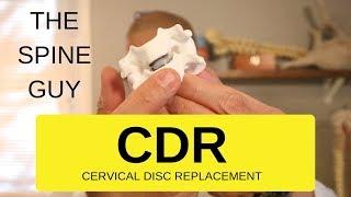 CERVICAL STENOSIS RADICULOPATHY - PART 6 - CERVICAL DISC REPLACEMENT