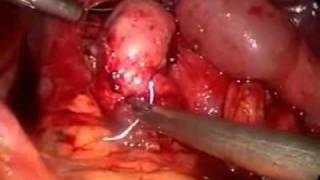 Minimally Invasive Resection Techniques for Gastroesophageal Junction GIST tumors