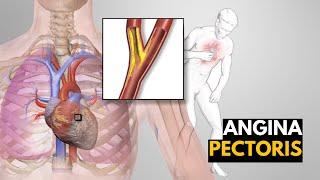 What is Angina Pectoris? Causes, signs and symptoms, Diagnosis and treatment.