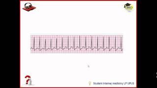 Ecg 3 of 56  Terminológia kmitov a vĺn s kazuistikou