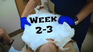 My Torn Achilles Mental & Physical Therapy (Week 2-3)