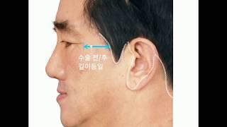 현재 안면거상 수술방법