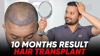 Hair Transplant in Kolkata | Best Results & Cost of Hair Transplant in Kolkata