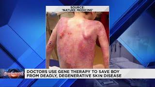 Experimental method saves young boy from degenerative skin disease