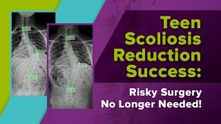 Teen Scoliosis Reduction Success: Risky Surgery No Longer Needed!