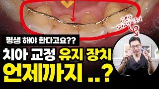 치아 교정 유지 장치 평생 한다고요?! | 교정 유지 장치 기간 딱! 정해드릴게요!