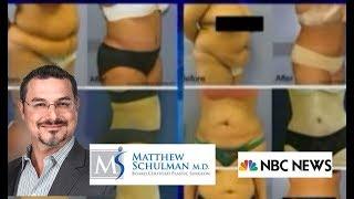 Smooth Tuck - Minimally Invasive Tummy Tuck - NBC News - Schulman Plastic Surgery