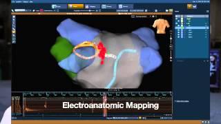 Part 3 of 5: Atrial Fibrillation Ablation - What to expect on the day of the procedure