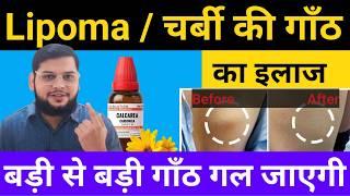 Lipoma Treatment | Best Homeopathic Medicine For Lipoma | चर्बी की गाँठ का इलाज