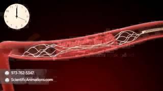 Mechanical Thrombectomy - Neurovascular stent deployment