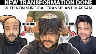 Finally Transformed Myself in 13 minutes with Non Surgical Hair Transplant in Guwahati 