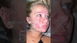 ACNE SKINCARE ROUTINE!(follow for more!) #acne #acnetreatment #skincare #skincareroutine #beauty