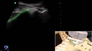 How To: Ultrasound Guided Sacro-iliac Injection - Sonosite Ultrasound 3D Video