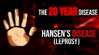 The 20 Year Disease - Hansen's Disease (Leprosy)