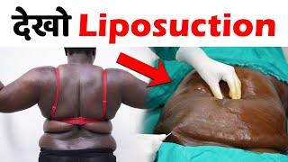 Liposuction surgery | Liposuction cost | Liposuction in delhi | Dezire Clinic