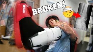 I JUST BROKE MY ANKLE!