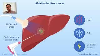 How is ablation used to treat liver cancer?