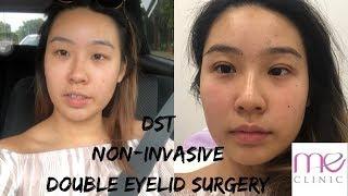 NO KNIFE DOUBLE EYE LID SURGERY// NON - INVASIVE// DST JOURNEY