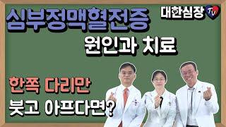 한쪽 다리만 붓고 아프다면?(심부정맥혈전증 원인과 치료)