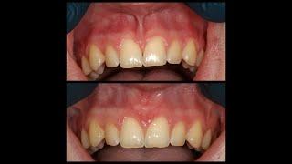 Maxillary Laser Lip Frenectomy