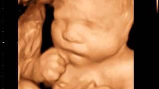 3D Ultrasound Burnaby | 3D Sono Image