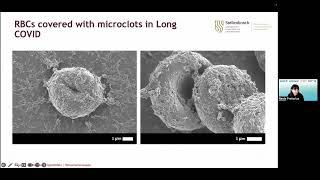 DZI-Webinar “The latest on microclots and platelet pathologies in Long/Post-COVID and ME/CFS”