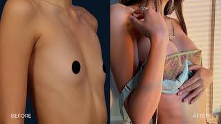 I GOT A BOOB JOB! | Before & After | Los Angeles