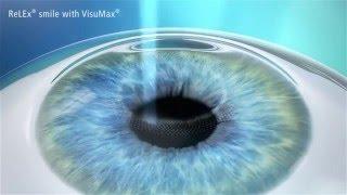 ReLEx smile Augenlaser OP Behandlung EyeLaser Wien - Zürich